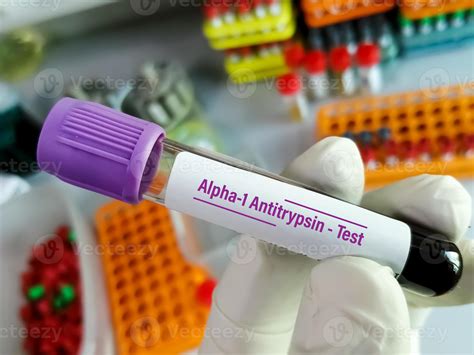 alpha 1 antitrypsin blood test bottle|high alpha 1 antitrypsin meaning.